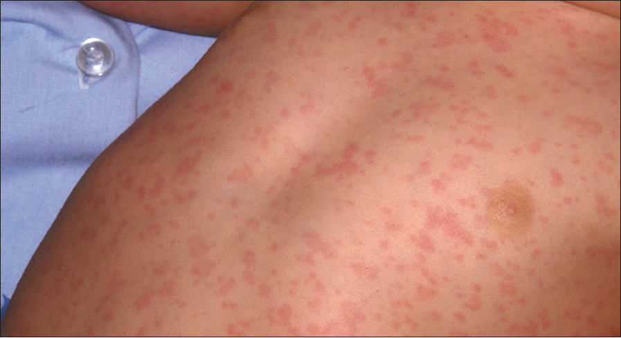 Adverse Reaction to MMR Immunization | Consultant360